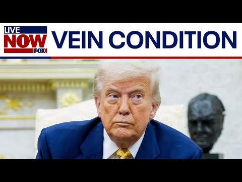 Video | President Trump diagnosed with chronic venous insufficiency: what is it?