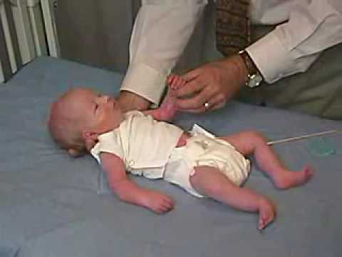 neurology exam: newborn-abnormal: Primitive Reflexes - Moro