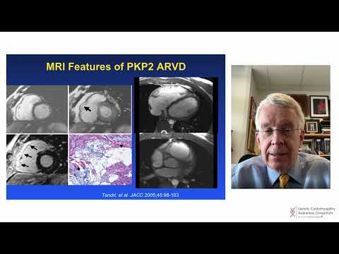Dr. Hugh Calkins discusses PKP2 gene variant.