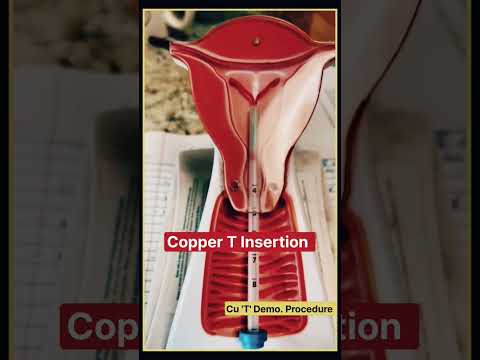 कॉपर टी कैसे डालते हैं ? Copper-t #IUCD #shorts #Neet #Medical #doctor #mbbs