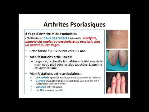 , title : 'Les Arthrites Juvéniles idiopathiques - Comité pédagogique de Pédiatrie  : Docteur : Djermane'