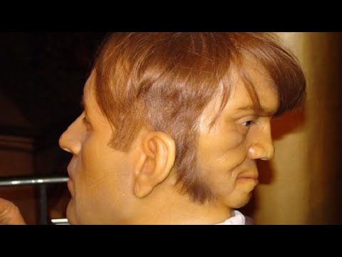 Kuracja koślawego Equinovarus deformacje stóp