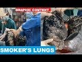 Doctors show a chain smoker’s donated lungs, the condition will shock you