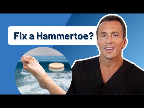 How do you fix a Hammer Toe? 