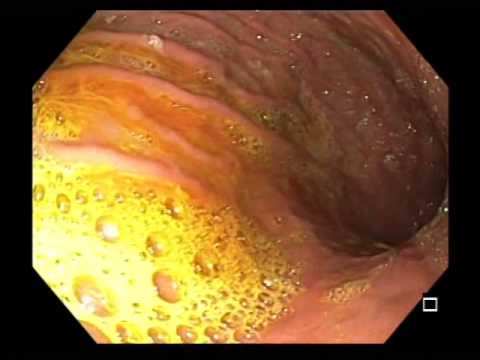 Gallereflux Gastritis - 2