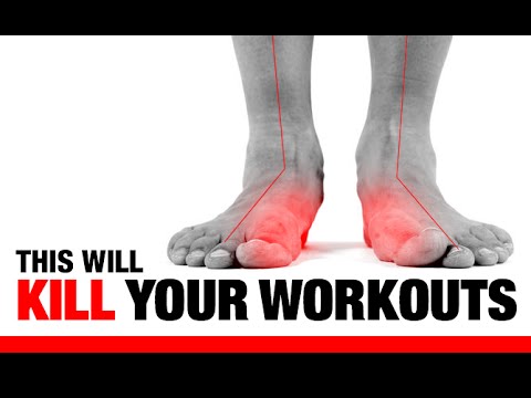 Can you "fix" flat feet? — MyFitnessPal.com