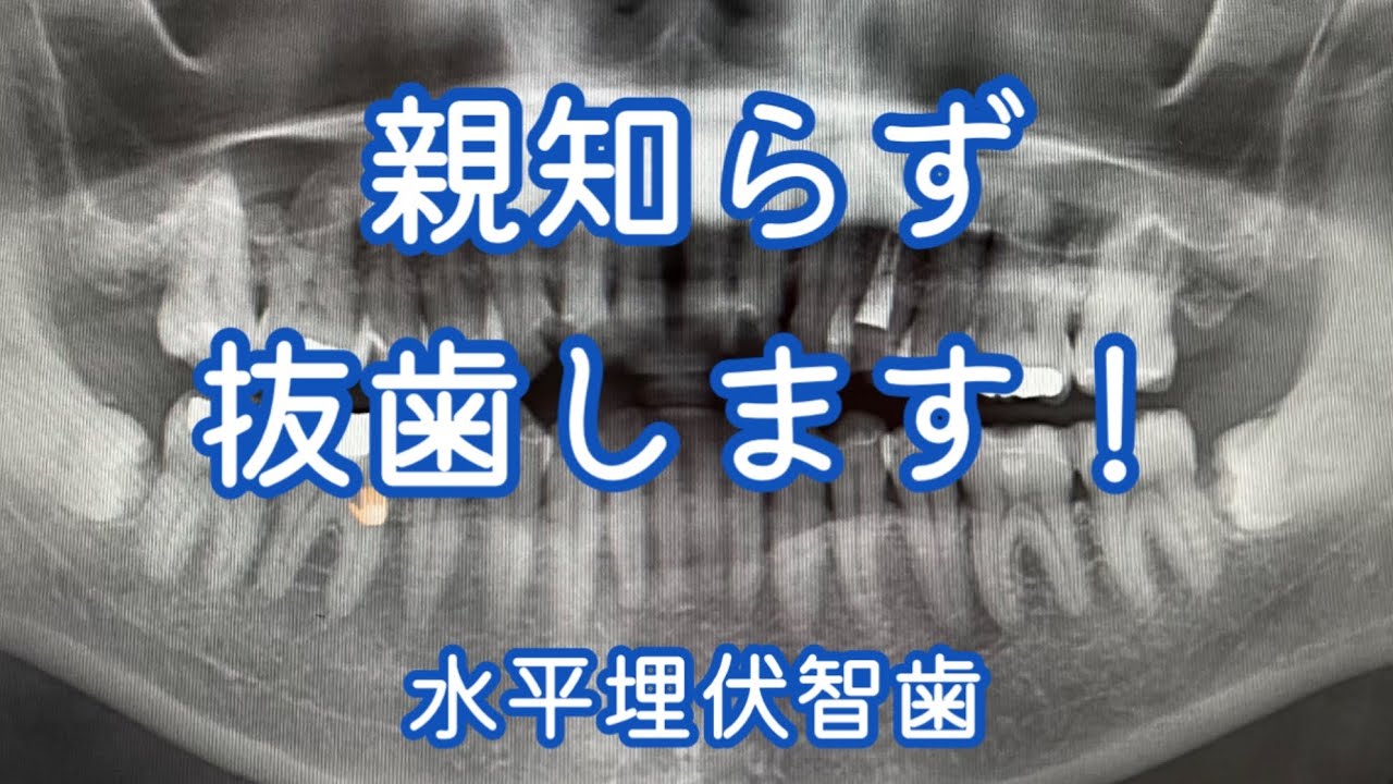 親知らず抜歯します！【水平埋伏智歯】
