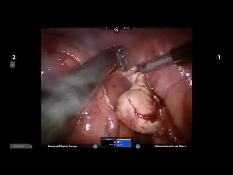 Robotic TLH with large Cervical Fibroid