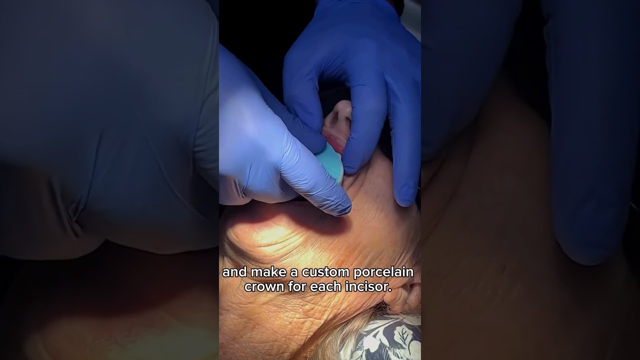 Prep for Crown Placement | Making Lakeland Smile