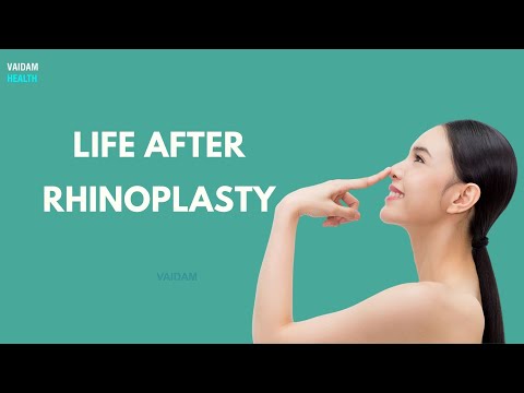 Life after Rhinoplasty