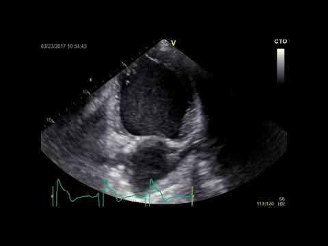 Apical 2-chamber view at the time of atypical RBBB - Supplementary video 5 [ID 269576]