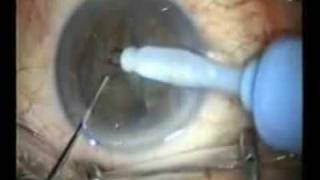 Cirugia de Catarata facoemulsificacion