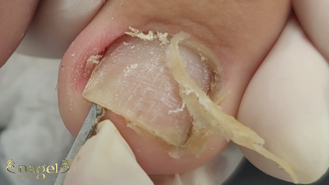 APRENDA A REMOVER A ONICOFOSE SEVERA (peeling químico) #satisfying #nails