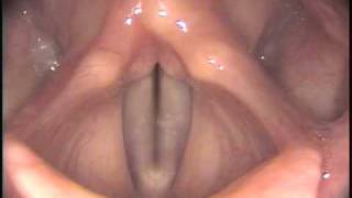 Stroboscopy: Rigid: Normal female vocal cords - gl