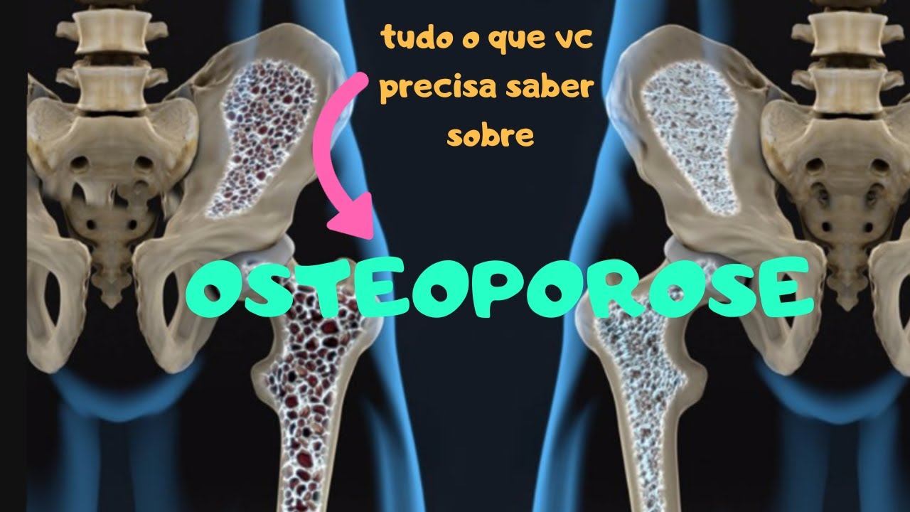 AULA 63: OSTEOPOROSE - tudo o que vc precisa saber!!!