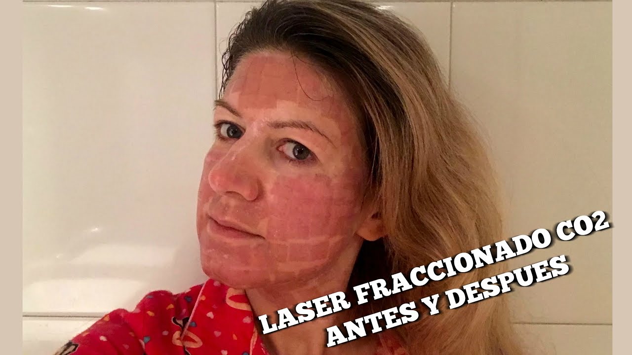Laser fraccionado CO2 acne, manchas y rejuvenecimiento - 1 experiencia