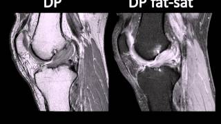 Degeneração mucóide do LCA