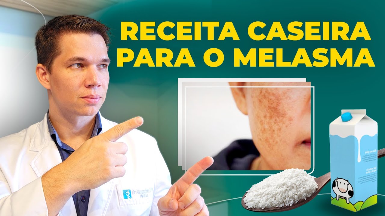 Melasma: Tratamento Caseiro para uma Pele Radiante