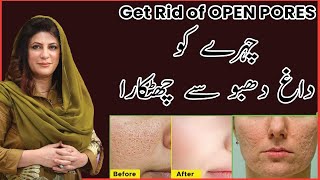Get Rid of OPEN PORES, ACNE SCARS AND LARGE PORES | 100% NATURAL REMEDY | DR BILQUIS SHAIKH