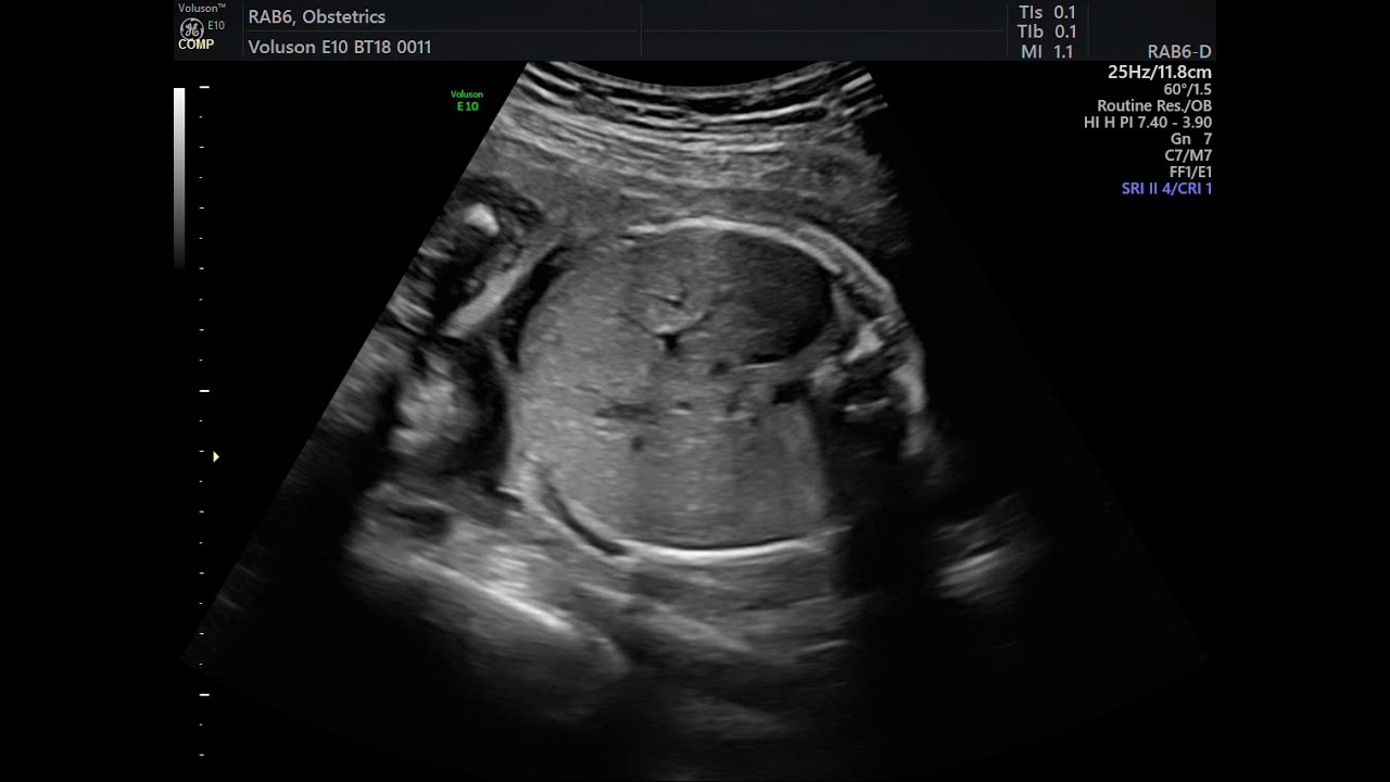 AVALIAÇÃO DE ABDOME FETAL EM EXAME MORFOLOGICO