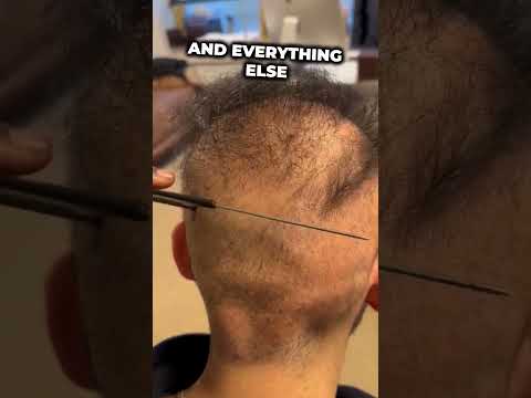 POOR HAIR TRANSPLANT RESULT: The worst use of 14,000 grafts imaginable!  #hairtransplantresults
