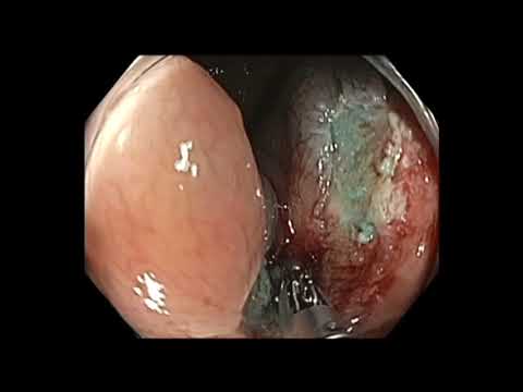 Colonoscopy: EMR of Ascending Colon SSA - Prior Incomplete Resection