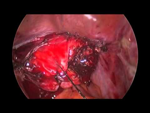 Uso de sutura de anclaje V-lock en laparoscopia