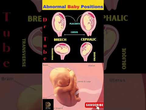 ❤️❤️Understanding Abnormal Baby Positions - Pregnancy positions - Baby position in womb #shortsfeed
