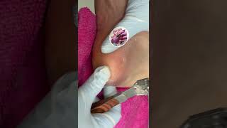 Ep_8475 Foot skin removal 👣 ทำไมผิวหนังแบบนี้..ถึงไม่ควรขัดออกคะ 😄 (clip from Thailand)