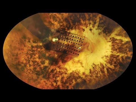 Have Scientists Created a Bionic Eye?