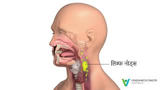 Hindi - What is Sinus Cancer / Nasal Cancer? Signs & Symptoms. Head and Neck Cancer