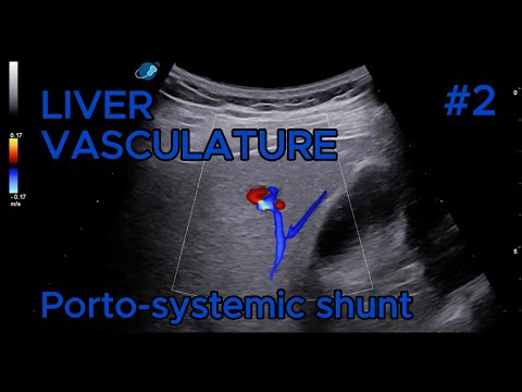 Spontaneous intrahepatic porto-systemic shunt video preview