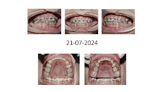 Tooth extraction case with the goal of closing the progressive space in the incisor region
