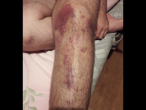 рубрика спортивная травма разрыв боковой связки коленного сустава