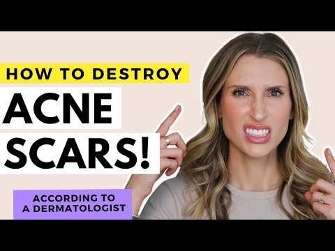Acne Scar Treatments That Work! | Dr. Sam Ellis
