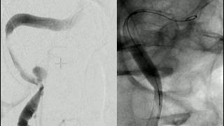 (English) Acute dissection of the ICA (Caresto implantation + PTA)