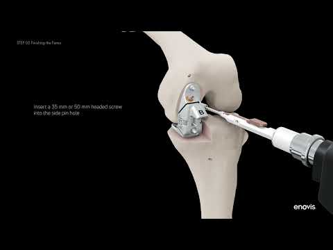 Physica ZUK - Virtual Surgical Technique