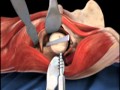 Femoral Head Osteotomy Animation - Direct Anterior Total Hip Replacement