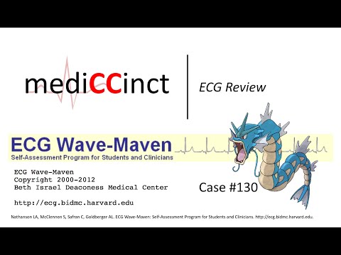 Normal Variant Early Repolarization (ECG Wave-Maven) Case #130