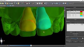 Visualizzare lo spostamento delle radici in 3D in un setup ortodontico con BlueSkyPlan