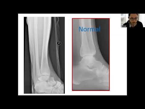 Fundamentals of Orthopaedics Session 15 Part 1 - Talar Fractures