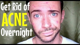 HOW TO GET RID OF ACNE OVERNIGHT | 3 Simple & Natural Ways | Cheap Tip #175