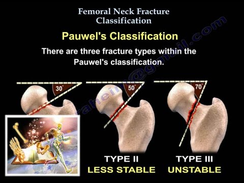 Femoral Neck Fracture Classification - Everything You Need To Know - Dr. Nabil Ebraheim