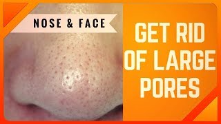 Large Pores Treatment | How To Get Rid Of Large Pores On Nose & Face In 3 Days | QUICKLY