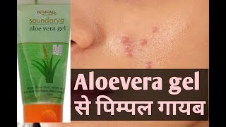 Remove pimples 100%  || Remove pimple with aloevera gel
