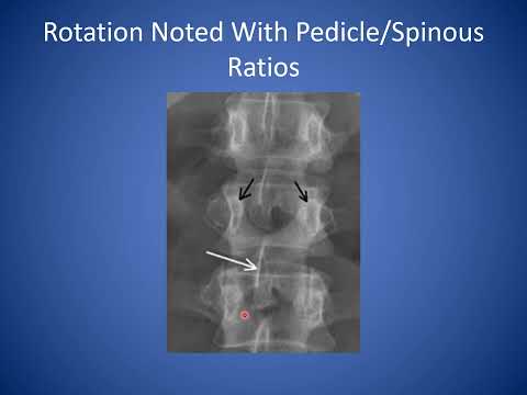 How to Read a Lumbar Spine X-ray | Reading Standing Spine X-ray
