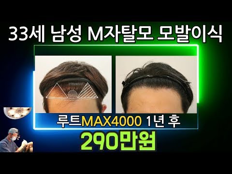 M자탈모 290만원  루트 MAX4000모발이식 33세 남성 모발이식 전후