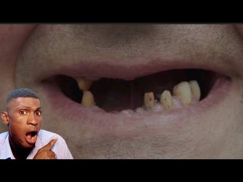 When you dream about your teeth being pulled out, what does it really mean and all its significan...