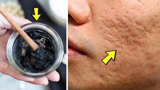 How to remove chickenpox holes, marks and scars on face at home naturally - Fast acting home remedy