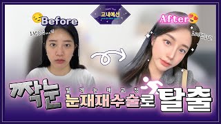 눈재재수술로 설인아되기 ㅣ고내예선ㅣ김형석 성형외과 전문의